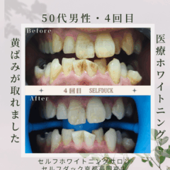 セルフホワイトニング