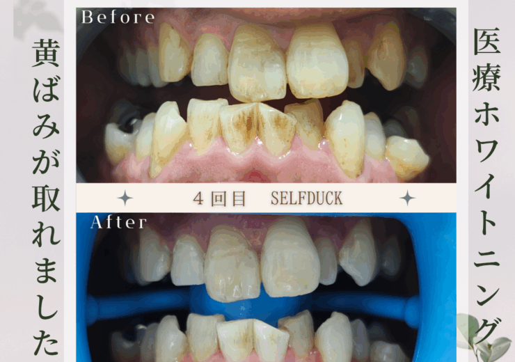 セルフホワイトニング