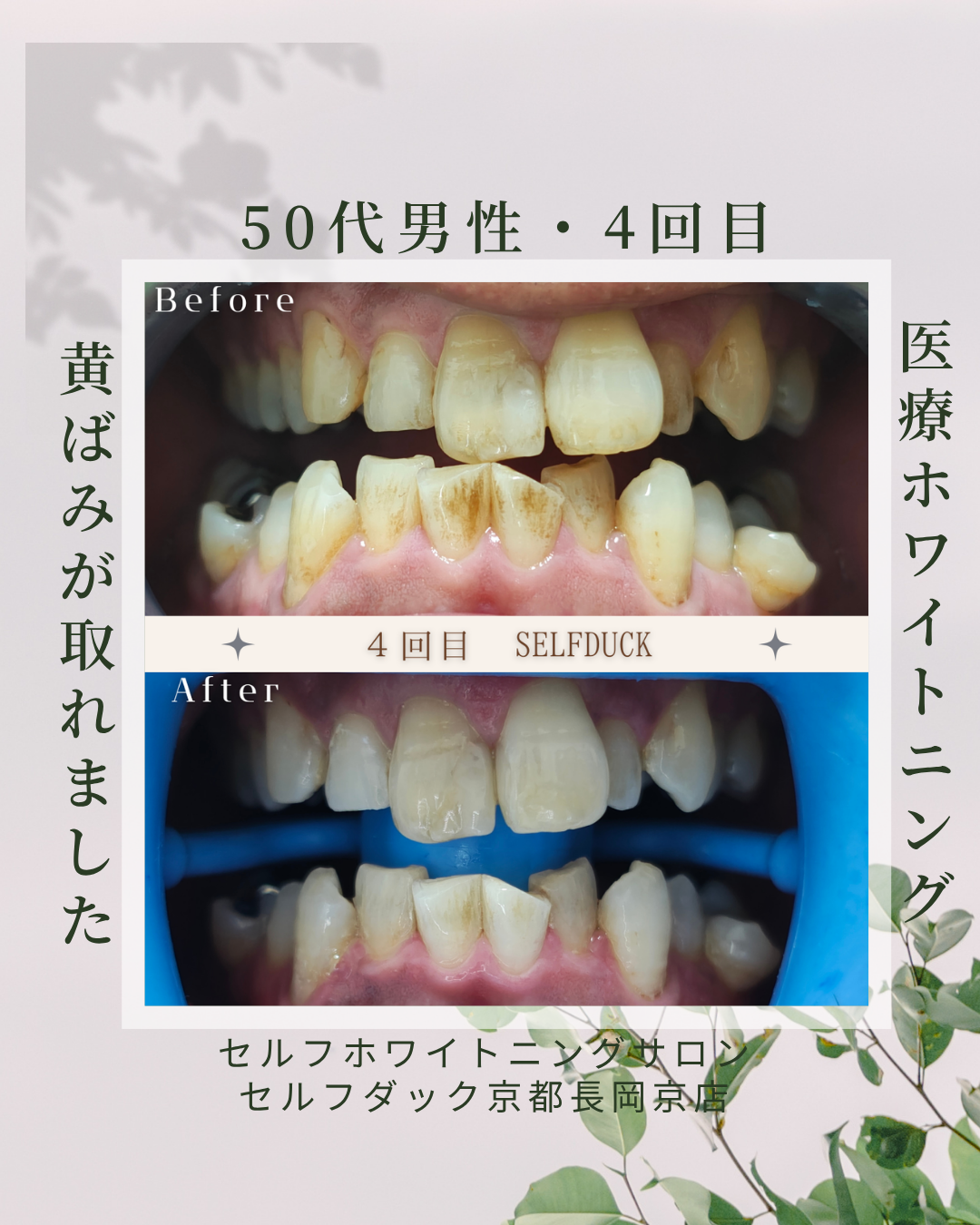 セルフホワイトニング